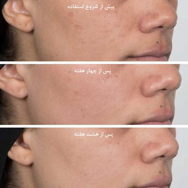 نیاسینامید چیست؟